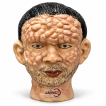 Leprosy Face Model